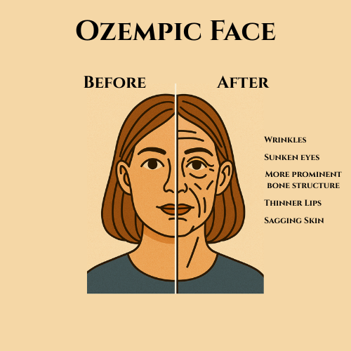 Ozempic Face